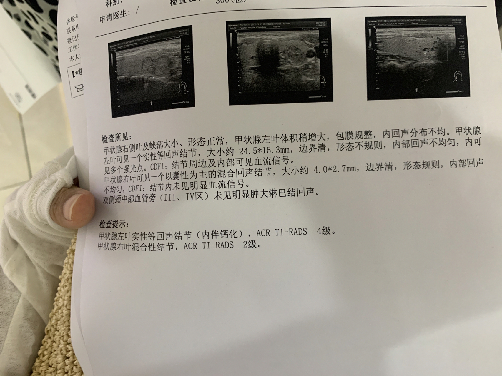 甲狀腺結(jié)節(jié)大小多少mm以上建議手術(shù)？全面解讀甲狀腺結(jié)節(jié)手術(shù)標(biāo)準(zhǔn)與注意事項，甲狀腺結(jié)節(jié)手術(shù)標(biāo)準(zhǔn)與注意事項，何時需手術(shù)？甲狀腺結(jié)節(jié)大小臨界點解析
