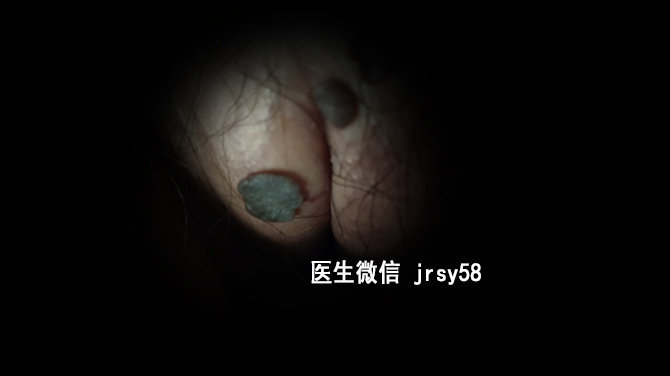 男性尖銳濕疣的自我治療指南，男性尖銳濕疣自我治療指南，實(shí)用方法與技巧