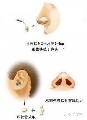關(guān)于做一個(gè)耳軟骨隆鼻需要多少錢的全面解析，耳軟骨隆鼻手術(shù)費(fèi)用全面解析，了解耳軟骨隆鼻所需費(fèi)用