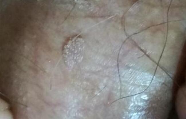 珍珠疹的十種癥狀圖片及其重要性，珍珠疹的十種癥狀圖片詳解及其重要性探討