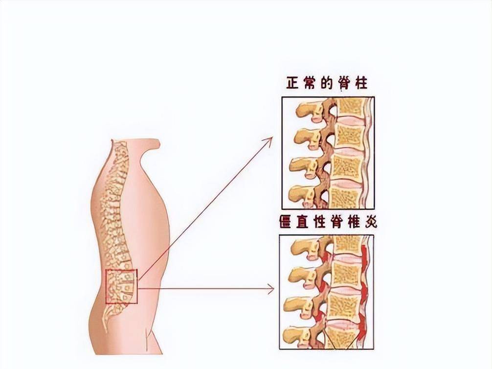 強直性脊柱炎能治愈嗎？——解析疾病與治療方法，強直性脊柱炎的治療方法及能否治愈解析