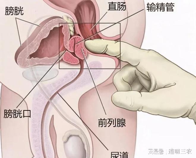 慢性前列腺炎的癥狀及其影響，深入了解與應(yīng)對，慢性前列腺炎的癥狀、影響及應(yīng)對之策詳解