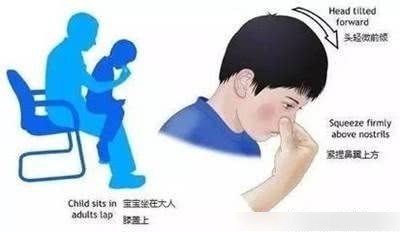 流鼻血的正確止血方法，流鼻血的正確止血方法詳解