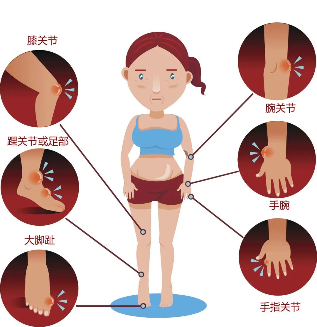痛風的幾個部位圖片及其相關(guān)知識解析，痛風疼痛部位圖示及知識解析