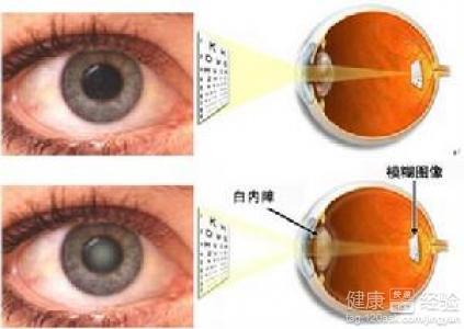 白內(nèi)障的早期癥狀及其識別，白內(nèi)障早期癥狀識別與預(yù)防