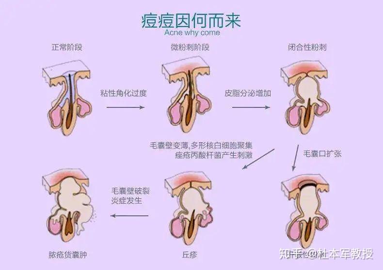 關(guān)于痤瘡激光治療的價(jià)格，你需要知道的一切，痤瘡激光治療價(jià)格全解析，你需要知道的一切